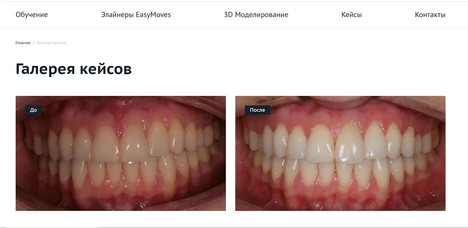 Clear Aligners: цифровизация производства элайнеров и обучения ортодонтов через личный кабинет